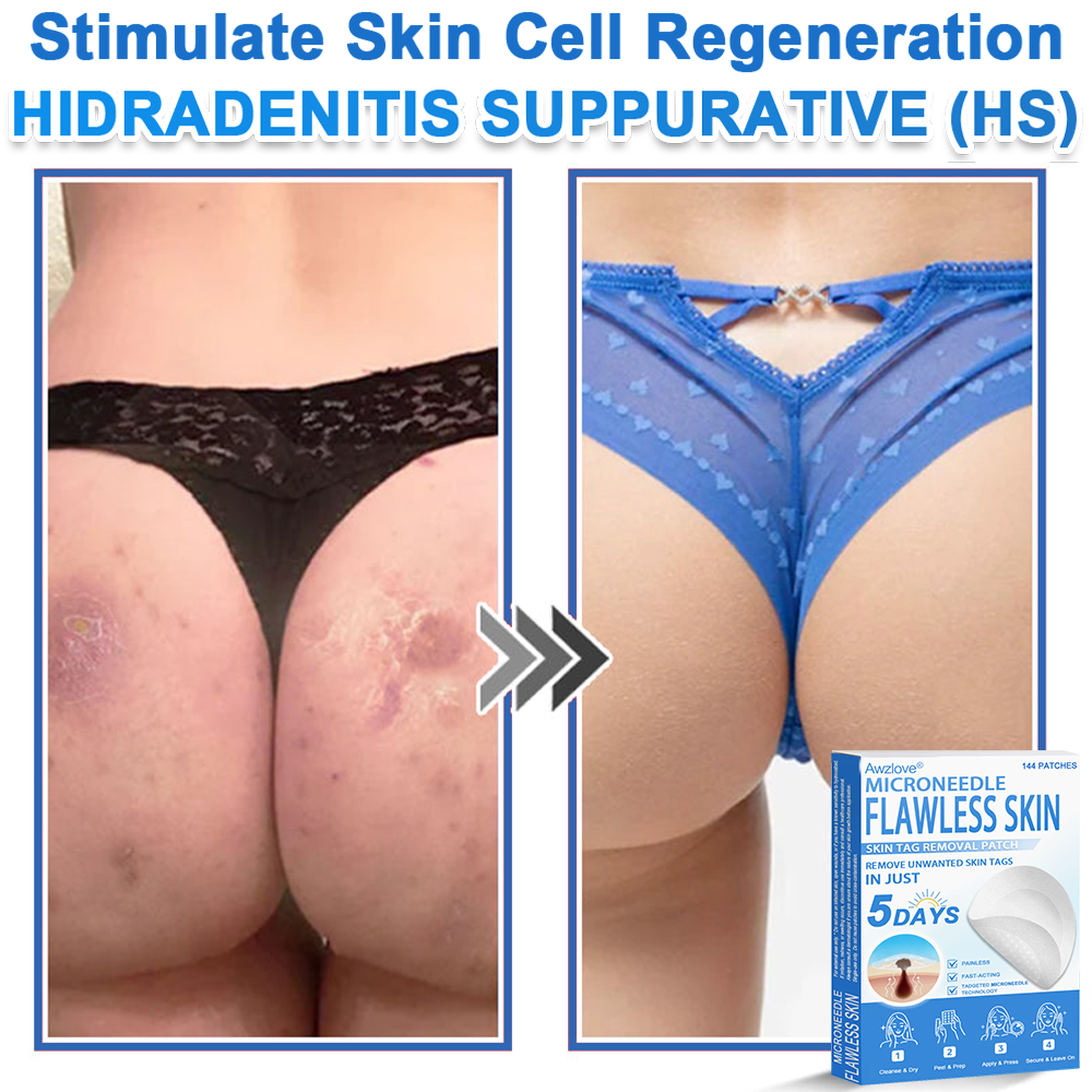 📌 Awzlove® 2-in-1 Microneedle & Hydrocolloid Patch | Raised Moles,Acne,  Flat Warts & Skin Tags Remover | Improves Wrinkles, Scars & Blemishes | Invisible Star Pimple Patches for Face & Body | 🎁