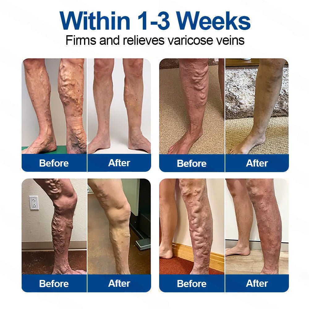 🇬🇧 Healrize® VeinTarget Microneedle Patch Instant Relief, Long-Term Results🦵💯