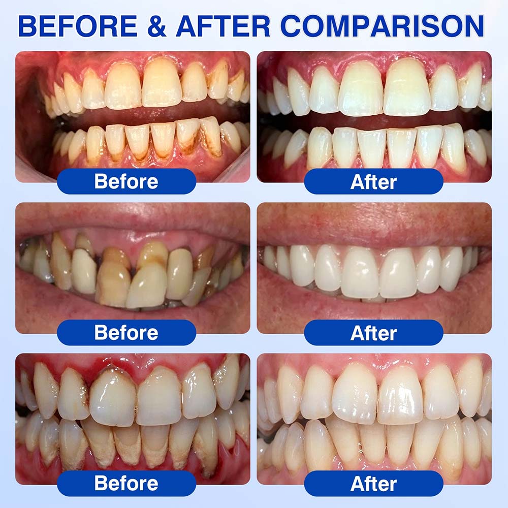 🦷🦢Healrize® GumRevive gel for the regeneration of the tooth-supporting apparatus (for bleeding gums, receding gums, and loose teeth)🐰